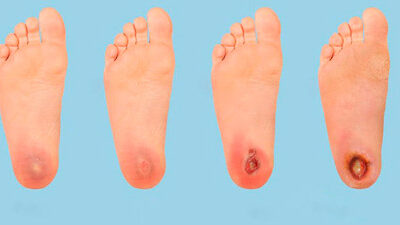 Como se producen las úlceras en los pies y como prevenirlas