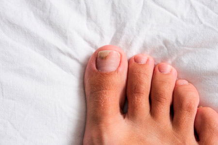 Como detectar onicomicosis en las uñas de los pies