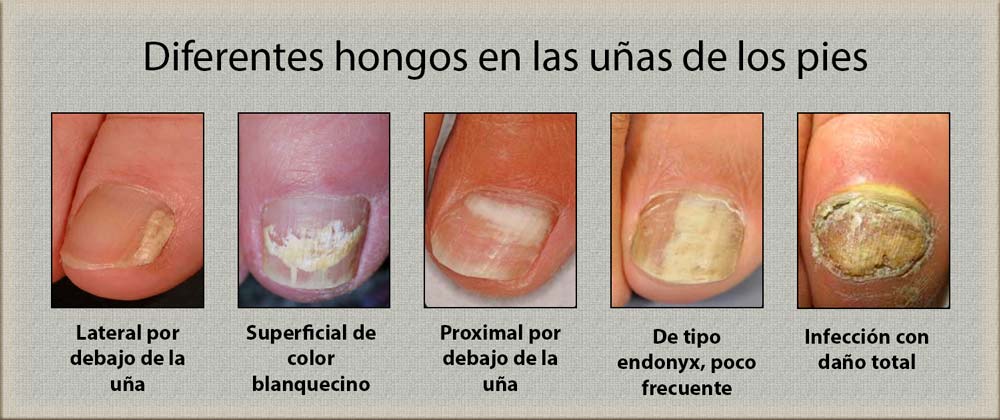 Como eliminar los hongos en las uñas de los pies