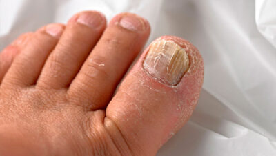 Como saber si tienes hongos en las uñas de los pies